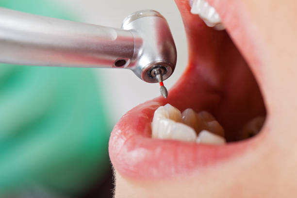 Best Emergency Dental Care for Broken or Chipped Teeth in Ephraim, UT